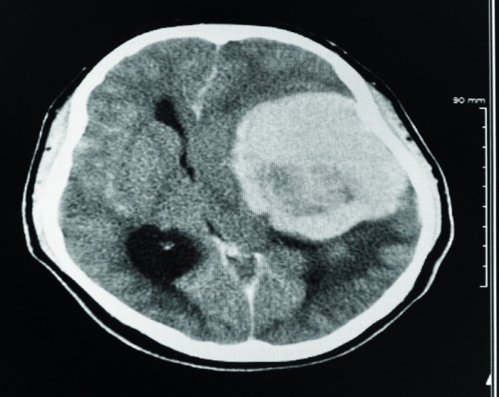 Tumour brain pineal migraines cystic discovers kelsey