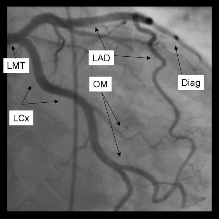 Femoral artery cardiac catheterization cath heart via coronary procedure angiography right through placement access lab left angiogram vascular stent nursing