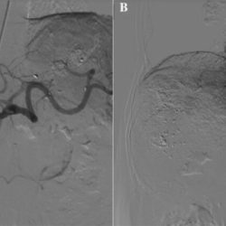 Hepatic artery aneurysms endovascular angiography preserving kawasaki