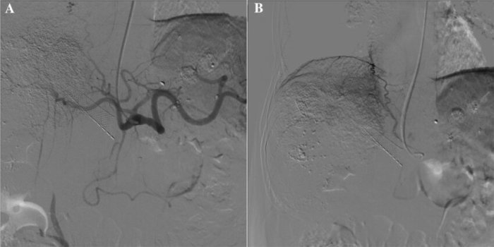 Hepatic artery aneurysms endovascular angiography preserving kawasaki