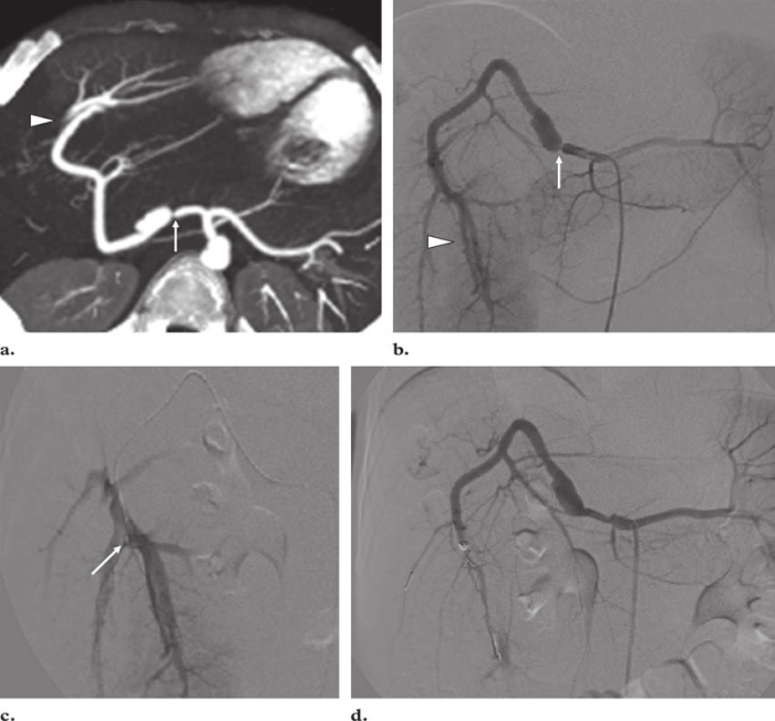 Percutaneous carotid catheterization and arteriogram were performed